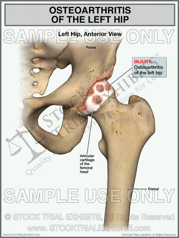 Osteoarthritis of the Left Hip