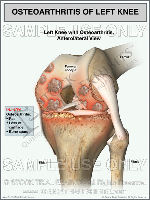 Osteoarthritis of the Left Knee