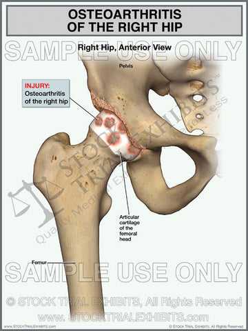 Osteoarthritis of the Right Hip