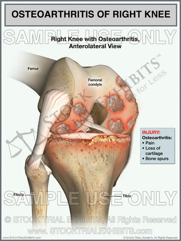 Osteoarthritis of the Right Knee