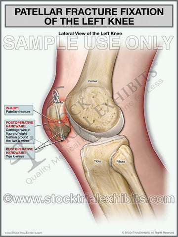 Patellar Fracture of Left Knee with Fixation, Lateral View