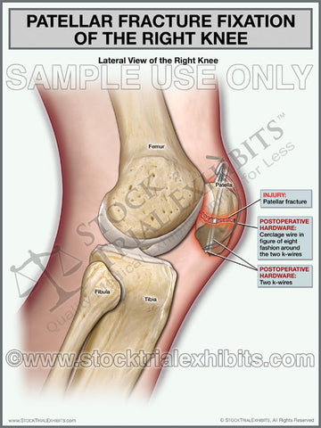 Patellar Fracture of Right Knee with Fixation, Lateral View