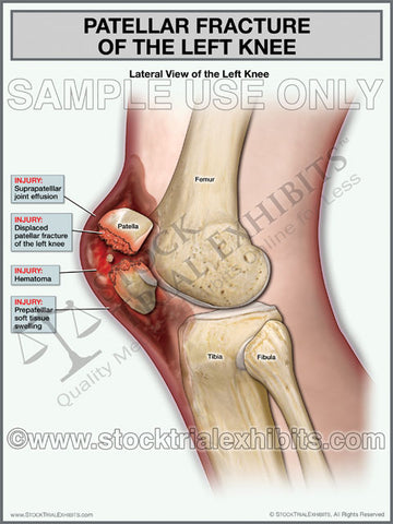 Patellar Fracture of Left Knee, Lateral View