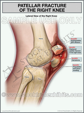 Patellar Fracture of Right Knee, Lateral View