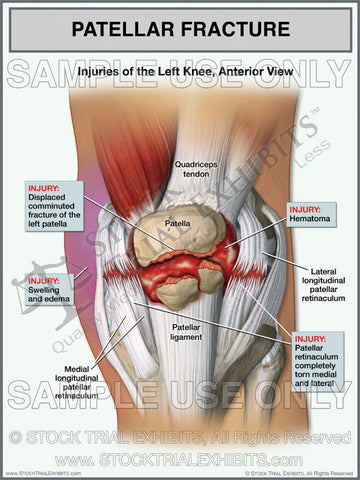 Patellar Fracture of the Left Knee with Torn Retinaculum