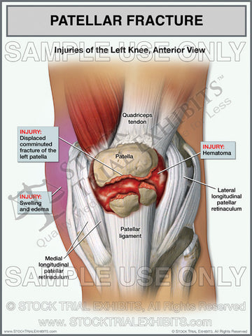 Patellar Fracture of Left Knee