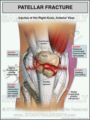 Patellar Fracture of the Right Knee with Torn Retinaculum