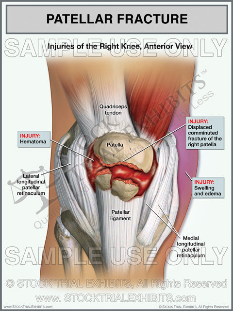 Patellar Fracture of Right Knee