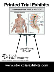 Printed Large Format Lumbar Epidural Injection L5-S1 Male Medical Trial Exhibit