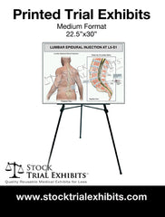 Printed Medium Format Lumbar Epidural Injection L5-S1 Male Medical Trial Exhibit