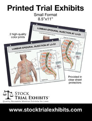 Printed Small Format Lumbar Epidural Injection L5-S1 Male Medical Trial Exhibit