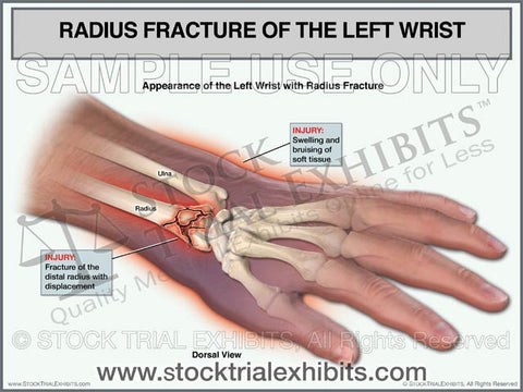Radius Fracture of the Left Wrist
