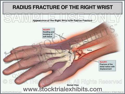 Radius Fracture of the Right Wrist