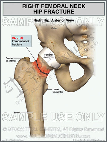 Right Femoral Neck Hip Fracture