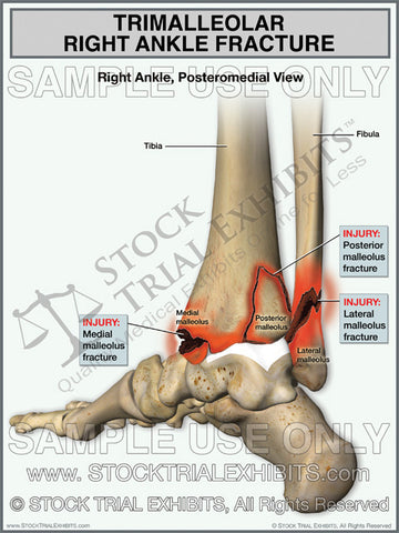 Trimalleolar Right Ankle Fracture