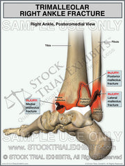 Trimalleolar Right Ankle Fracture Trial Exhibit — medial, lateral & posterior malleolus fractures shown in posteromedial view. Stock medical illustration for personal injury attorneys. Instant Download.
