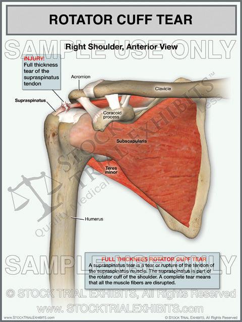 This trial exhibit shows a Full Thickness tear of the Supraspinatus tendon of the Rotator Cuff of the Right Shoulder, in the anterior view. This medical trial exhibit includes descriptive injury labels with anatomy labels of shoulder.