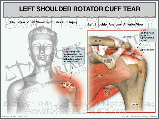 Rotator Cuff Tear of the Left Shoulder - Female Orientation