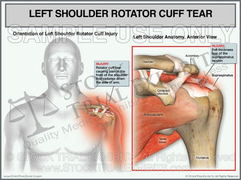 Rotator Cuff Tear of the Left Shoulder - Male Orientation