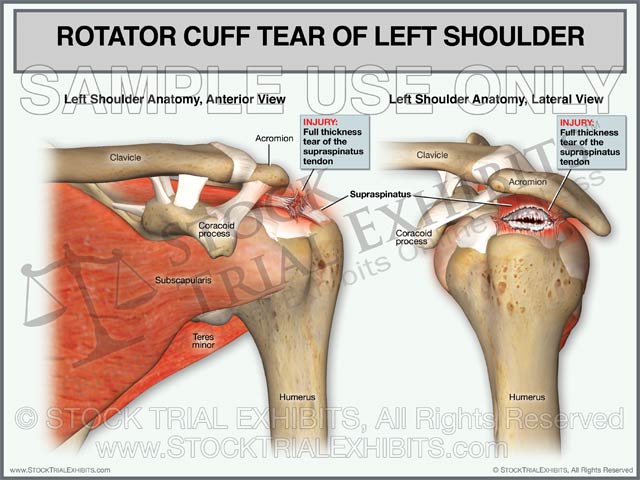 Rotator Cuff Tear of Left Shoulder - Anterior and Lateral Views