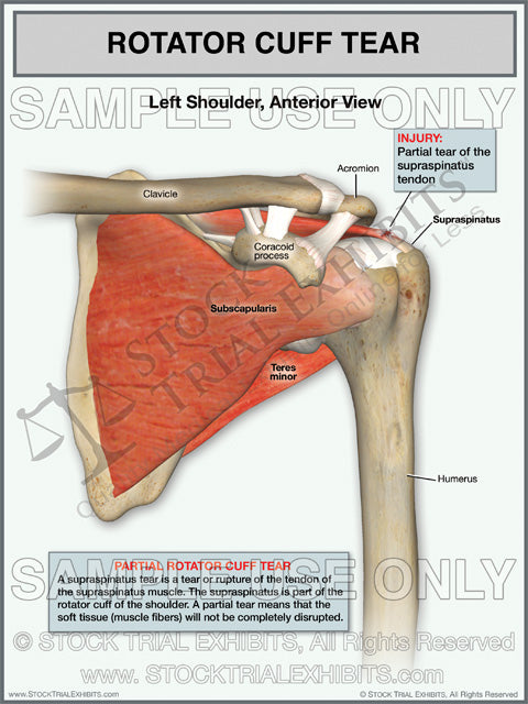 This trial exhibit shows a partial tear of the Supraspinatus tendon of the Rotator Cuff of the Left Shoulder, in the anterior view. This medical trial exhibit includes descriptive injury labels with anatomy labels of shoulder.