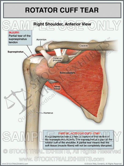 This trial exhibit shows a partial tear of the Supraspinatus tendon of the Rotator Cuff of the Right Shoulder, in the anterior view. This medical trial exhibit includes descriptive injury labels with anatomy labels of shoulder.