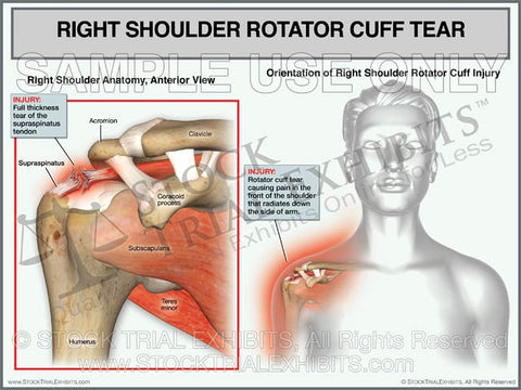 Rotator Cuff Tear of the Right Shoulder - Female Orientation