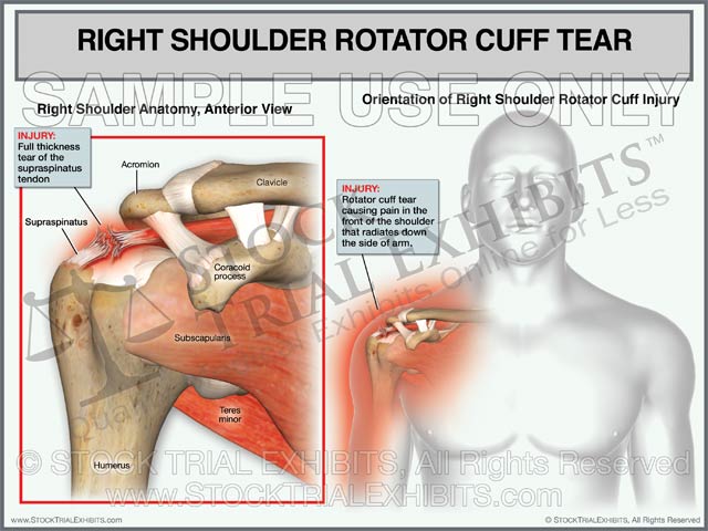 Rotator Cuff Tear of the Right Shoulder Male Orientation Stock