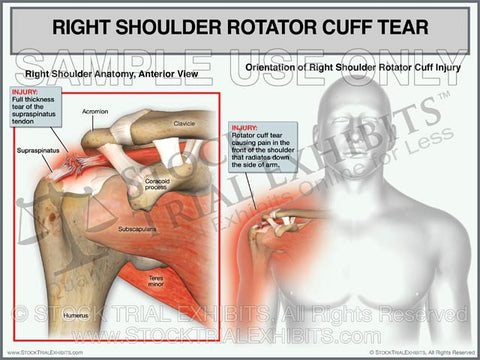Rotator Cuff Tear of the Right Shoulder - Male Orientation