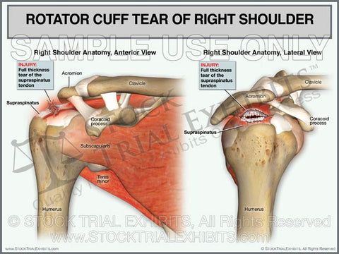 Rotator Cuff Tear of Right Shoulder - Anterior and Lateral Views