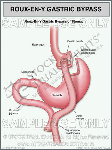 Roux En Y Gastric Bypass of Stomach Trial Exhibit