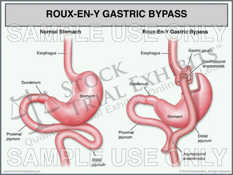 Roux En Y Gastric Bypass Trial Exhibit