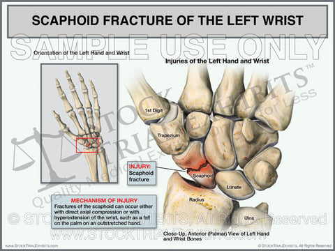 Scaphoid Fracture of the Left Wrist