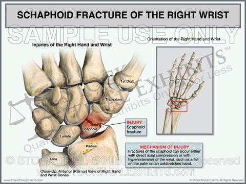 Scaphoid Fracture of the Right Wrist
