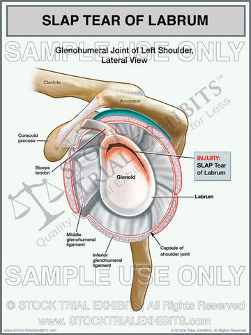 SLAP Tear Labrum Injury of the Left Shoulder