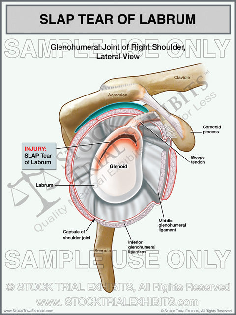 SLAP Tear Labrum Injury of the Right Shoulder