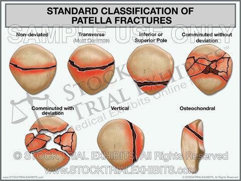 Standard Classification of Patella Fractures Trial Exhibit