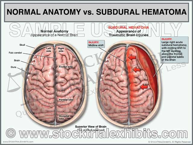 This trial exhibit graphically depicts a comparison of normal brain anatomy against a Subdural Hematoma Traumatic Brain Injury, in the superior view. This demonstrative exhibit shows normal brain anatomy before an accident or injury compared against a post-accident brain injury of a large right acute subdural hematoma with midline shift to the left. This exhibit includes descriptive labels of all relevant brain anatomy and traumatic brain injury.