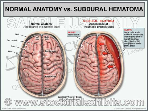 Subdural Hematoma vs Normal Brain Anatomy