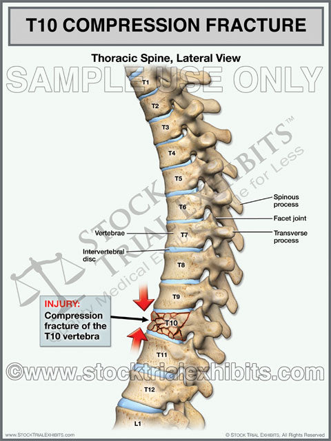 This trial exhibit graphically depicts a T10 compression fracture of the thoracic spine, shown in the lateral view. Medical illustration of full thoracic spine showing compression fracture injuries of T10 vertebra, with descriptive labels of anatomy and fracture injury.