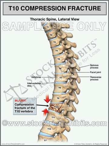 T10 Compression Fracture of the Thoracic Spine