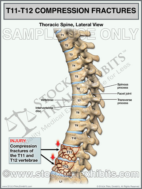 This trial exhibit graphically depicts T11-T12 compression fractures of the thoracic spine, shown in the lateral view. Medical illustration of full thoracic spine showing compression fracture injuries of T11 and T12 vertebrae, with descriptive labels of anatomy and fracture injuries.