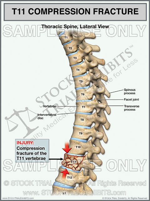 This trial exhibit depicts T11 compression fracture injury of the thoracic spine, shown in the lateral view. Depicted with descriptive labels of anatomy and T11 fracture injury of the thoracic spine highlighting injury. 