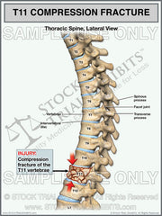 This trial exhibit depicts T11 compression fracture injury of the thoracic spine, shown in the lateral view. Depicted with descriptive labels of anatomy and T11 fracture injury of the thoracic spine highlighting injury. 