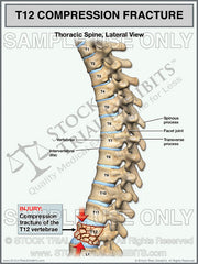 T12 Compression Fracture of Thoracic Spine Trial Exhibit | Stock Medical Illustration | T12 Vertebral Fracture for Personal Injury Attorneys | Instant Download
