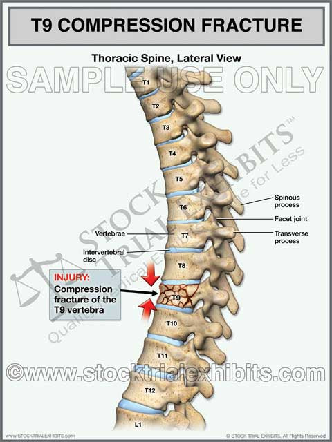 T9 Thoracic Compression Fracture Trial Exhibit Stock Trial Exhibits t9-thoracic-compression-fracture-trial-exhibit-stock-trial-exhibits