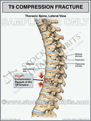 This trial exhibit graphically depicts a T9 compression fracture of the thoracic spine, shown in the lateral view. Detailed medical illustration of the thoracic spine showing compression fracture injury with resulting loss of vertebral height of T9 vertebra. This exhibit includes descriptive labels of anatomy and fracture injury.