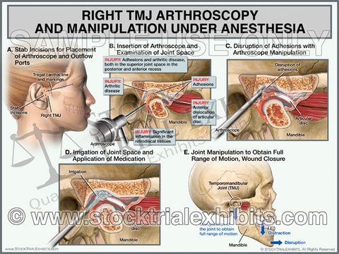 TMJ Right Arthroscopy with Manipulation - Female