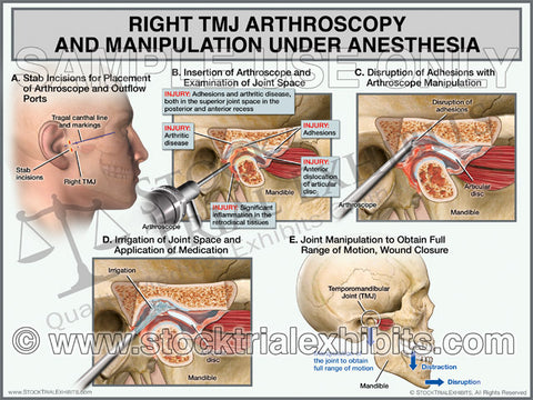 TMJ Right Arthroscopy with Manipulation - Male