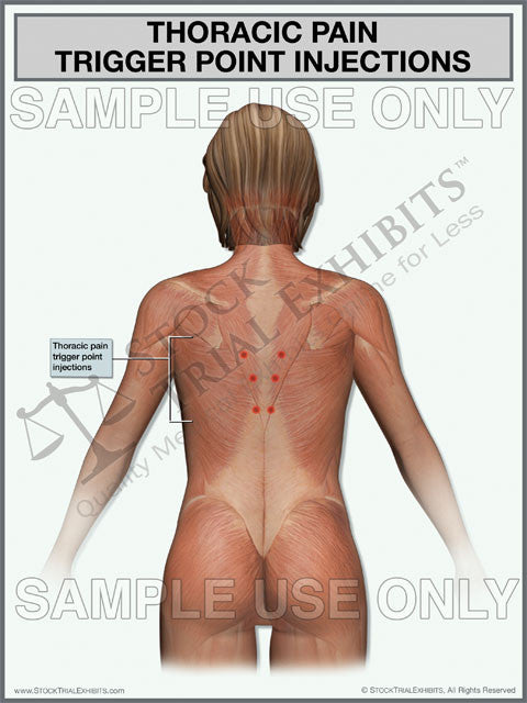 Thoracic Spine Trigger Point Injections. This trial exhibit depicts trigger point injections for pain management of thoracic pain, shown in a female body. Needles going into possible injection sites of thoracic muscular anatomy with descriptive labels. 
